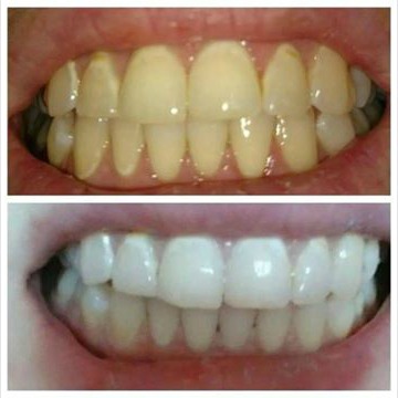 teeth-before-after
